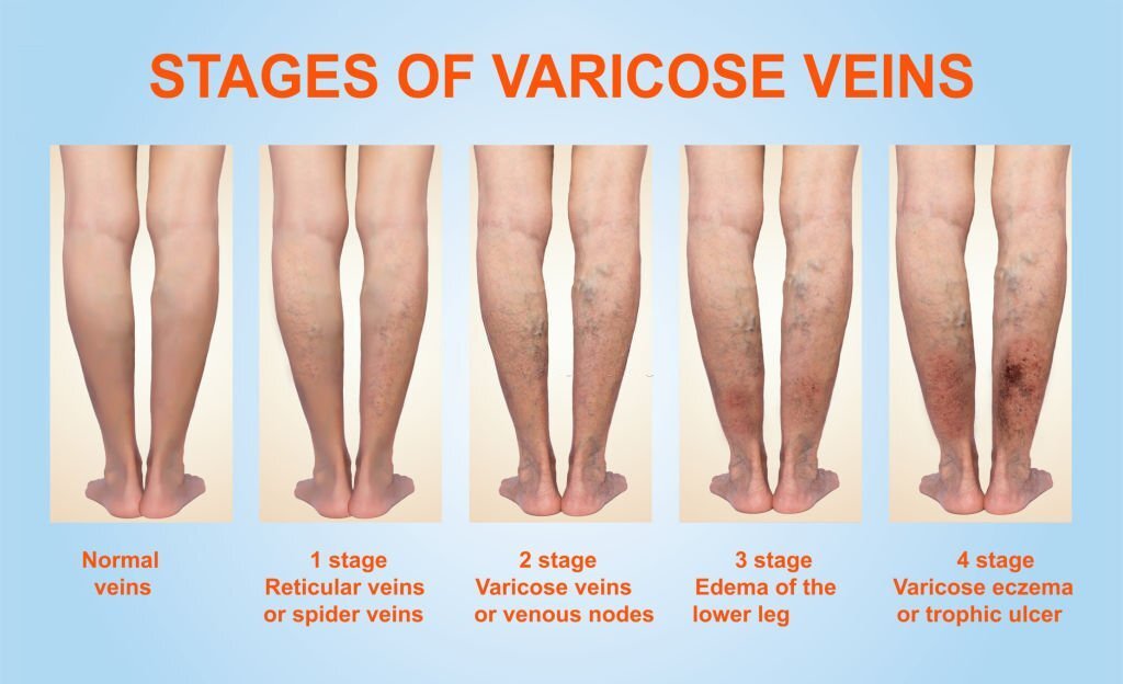 Varicose veins on a female senior legs. The stages of varicose veins