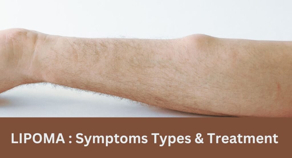 Ayurvedic treatment for lipoma in Lajpat Nagar