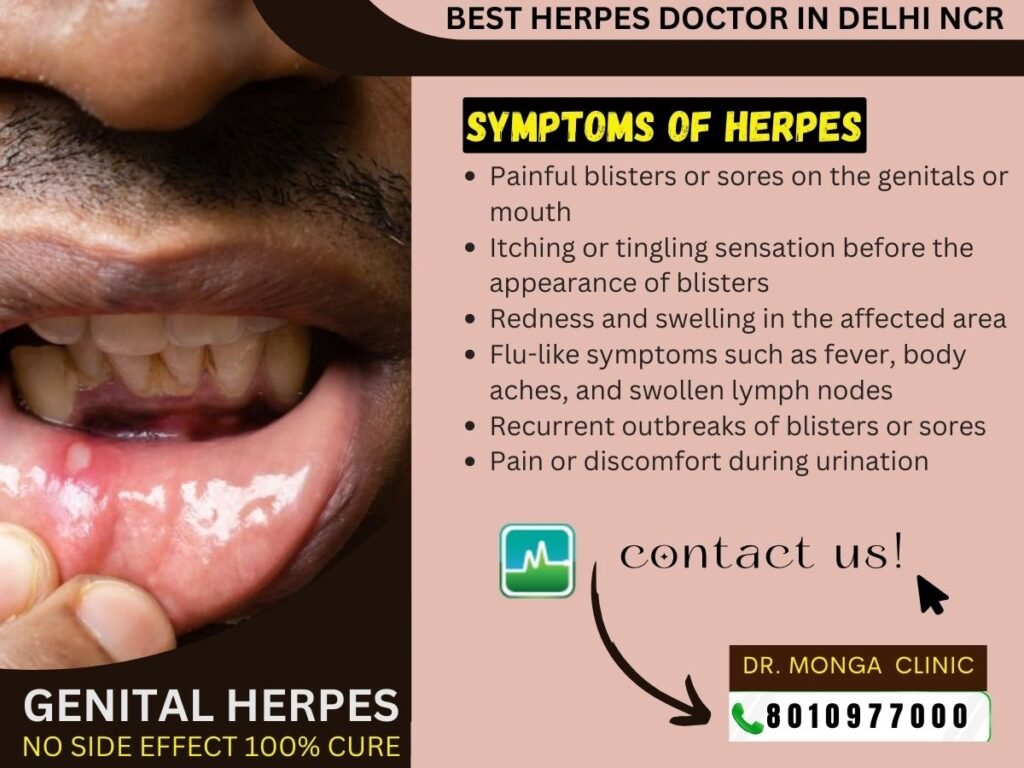 Genital Herpes