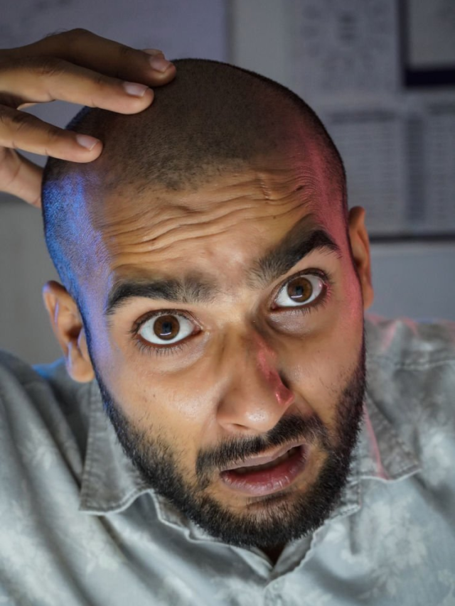 Baldness Scarring You?? Conquer with Our One-Week Transformation Tips