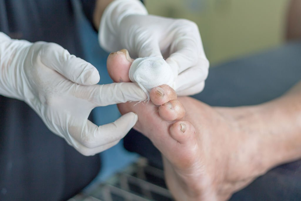 Foot Ulcer Treatment in Delhi